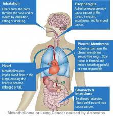 Mesothelioma Years After Exposure Mesothelioma Mesothelioma Cancer Idiopathic Pulmonary Fibrosis