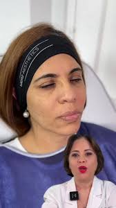 Aromizacion facial con toxina botulinica 🪄