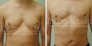 Uk Gynecomastia Clinics Male Breast Reduction Uk Gynecomastia Surgery London