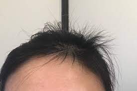 Tips For Taming Postpartum Hair Growth August 2017 Babies Forums What To Expect