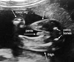 ultrasonla cinsiyet tahmini