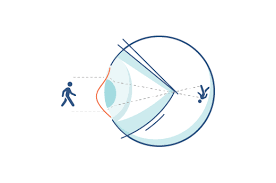 What Is Astigmatism Causes Symptoms Test Acuvue Uk