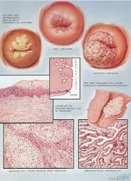 Image result for Colposcopy
