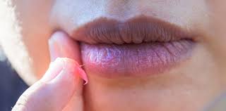 Boqueras Grietas Y Labios Palidos Causas Y Remedios