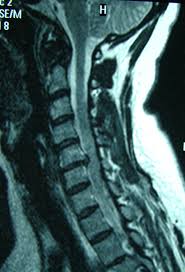 Hernia de disc apare dacă discul se fragmentează și ajunge să comprime rădăcinile nervoase sau măduva spinării aflate în canalul spinal din vecinatatea sa. Extensie CervicalÄƒ