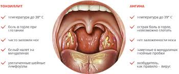 Prichiny Simptomy I Metody Lecheniya Gnojnyh Probok V Mindalinah