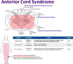 Spinal Cord Injury Foamcast Anterior Cord Syndrome Neuro Spinal Cord Injury Spinal Cord Anatomy Spinal Cord