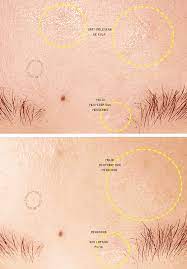 Mentholatum Acnes Sealing Gel Review Mentholatum