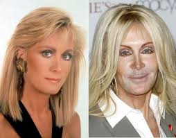 28.01.2016 · plastic surgery gone wrong #4: Utah Facelift Photo Gallery Salt Lake City Facial Plastic Surgery Photo Gallery Dr Bitner Celebrity Plastic Surgery Plastic Surgery Bad Plastic Surgeries