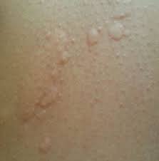 Image result for Hives