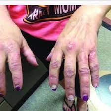 Granulomas And Swelling Of The Joints Before Minocycline Rifampin And Download Scientific Diagram
