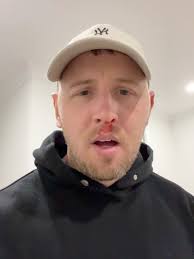 This one’s a long time coming but finally… I can breathe 👃💨, Such a weird  feeling getting this amount of air through, what have I been missing out