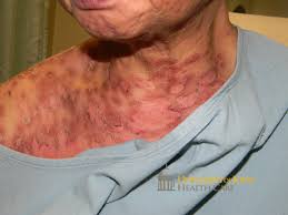 Image result for Pemphigus