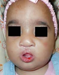 case 4): A 7 months female with CBCL with protruding premaxilla and...