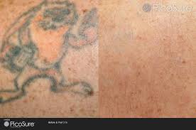 The price for each excision was $850, and the consultation was $50. Tattoo Removal