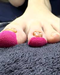 Image result for Onychogryphosis feet