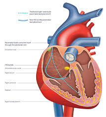 Create mixes with millions of tracks and share your vibe with friends! The Medical Center Navicent Health Leads State In Innovative Pacemaker Implant Procedure