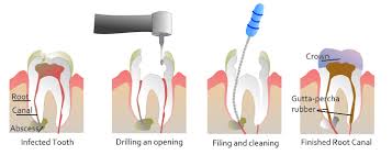 By pressing your finger against the upper and lower gums, you can look for swollen areas (which will probably be at least a little sore) around the area of the tooth in question. Painless Root Canal Treatment Dental Treatments Medicover Fogaszat