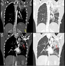 Image result for Pulmonary Contusion