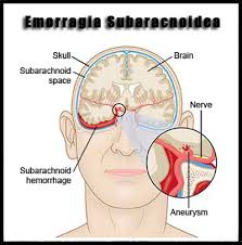Le emorragie cerebrali sono condizioni mediche di emergenza, con ramificazioni potenzialmente alteranti la vita. Emorragia Subaracnoidea Medicinafisica It