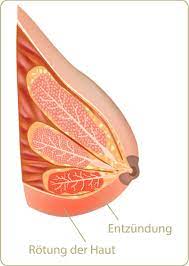 Mastitis Ursachen Tipps Behandlung Mooci