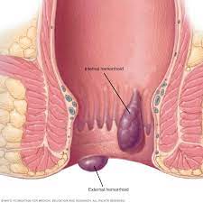 Hemorrhoids - Symptoms And Causes - Mayo Clinic