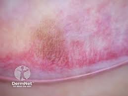 Image result for Macule