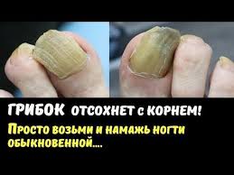 как вылечить грибок на ногтях ног в домашних условиях Pin Na Doske A Saude