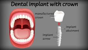 Dental Implant With Crown Free Vector Freepik Freevector Education Medical Crown Cartoon In 2020 Dental Implants Dental Implants