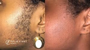 Generally, it gets a bit complicated for people with dark to black skin tones, because of the high levels of melanin in their skin. Laser Hair Removal Dark Skin Pulse Light Clinic London