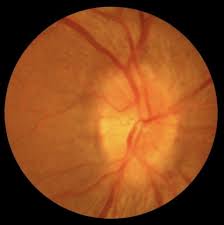 Image result for Optic Neuritis