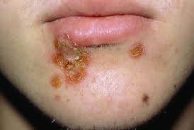 This video/podcast presents an approach to the diagnosis and management of viral rashes in children. 9 Common Rashes With Blisters
