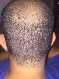 Donor Area After Fue Procedure 14 Days Later As You Can See There Is No Visible Scarring He Had Over 2500 Grafts Taken Out Hair Restoration Hair Restoration