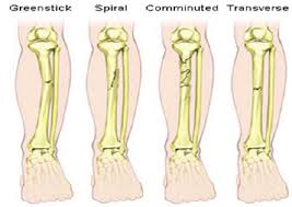 Examples of long bones include the femur, tibia, fibula, metatarsals, and phalanges. Different Types Of Long Bone Fracture 18 Download Scientific Diagram
