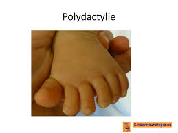 Kinderneurologie Eu