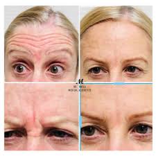 Botox for migraines · botox for underarm sweating · botox for gummy smile · botox for tmj · botox for square jaw. Botox Washington Uk Dr Matla Aesthetic Doctor And Gp