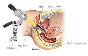 During a pap test, the doctor takes a sample of cells. Cervical Cancer Diagnosis Pap Smear And Colposcopy Kkh