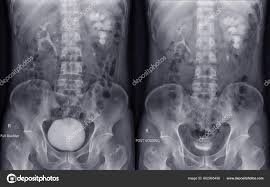 Image result for Intravenous Pyelogram