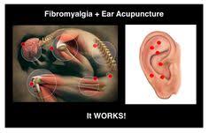 Fibromyalgia It Can Be Debilitating Acupuncture Works Auriculo 3d Allows You To Create Custom Protocols For Your Pati Acupuncture Acupunture Fibromyalgia