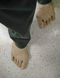 Apa sajakah yang anda alami ketika memotong semua kuku tangan dan kaki sampai bersih terutama ujung kanan dan kiri jempol kaki? Memahami Seluk Beluk Nyeri Kaki Akibat Bunion Rs St Carolus Rumah Sakit Di Jakarta Pusat