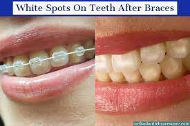 White spots on teeth indicates the initial stage of a cavity. White Spots On Teeth After Braces Causes How To Fix Orthodontic Braces Care