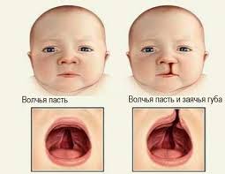 Zayachya Guba Ili Volchya Past U Detej Opisanie I Harakteristika Zabolevanij Metody Terapii I Korrekcii Oficialnyj Sajt Gbuz Rodilnyj Dom 2 G Magnitogorsk