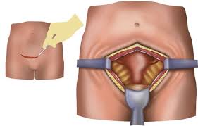 Afterwards i had very bad pain in my lower back. Post Hysterectomy Pain Relief