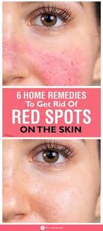 How To Get Rid Of Red Spots On Face 6 Home Remedies And Tips Since The Causes Are Many Proper Identification In 2020 Red Spots On Face Spots On Face Redness On Face