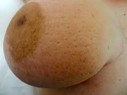 Inflammatory breast cancer is a form of breast cancer that leads to inflammation and swelling of the lymphatic channels of the breast. What Are The Histologic Characteristics Of Inflammatory Breast Cancer Ibc