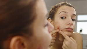 Bekas jerawat sulit untuk ditutupi bahkan dengan concealer dan membuat makeup jadi terlihat kurang bagus. 11 Cara Menghilangkan Bekas Jerawat Dengan Cepat Dan Alami