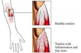 Healthy Torn Tendon Tennis Elbow Treatment Tennis Elbow Massage Therapy