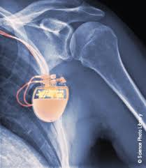 What does icd abbreviation stand for? A Single Defibrillation Safety Margin Test Is Sufficient In Most Icd Patients Experience From A Uk Tertiary Centre The British Journal Of Cardiology