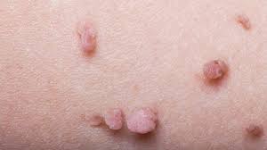 Skin is the largest organ of the body and is made up of various cells in constant motion. What Are Skin Tags What To Learn From My Std Scare Everyday Health