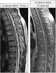 Ann jozefien andrea (an) swartenbroekx (genk, 11 juli 1969) is een belgische actrice, presentatrice, scenariste en zangeres. Localised Multiple Sclerosis Like Disease After Irradiation Of The Cervicothoracic Spinal Cord Multiple Sclerosis And Related Disorders
